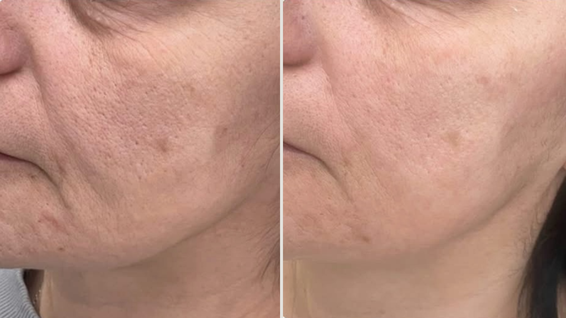 Подобряване на текстурата на кожата — преди и след