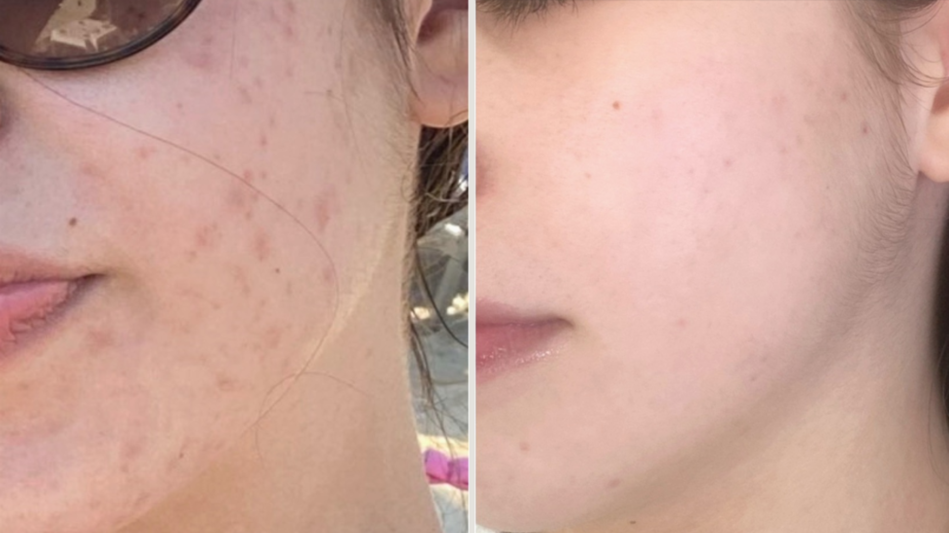 Терапия за проблемна кожа — преди и след